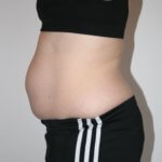 Rektusdiastase, ein nicht schwinden wollender Schwangerschaftsbauch