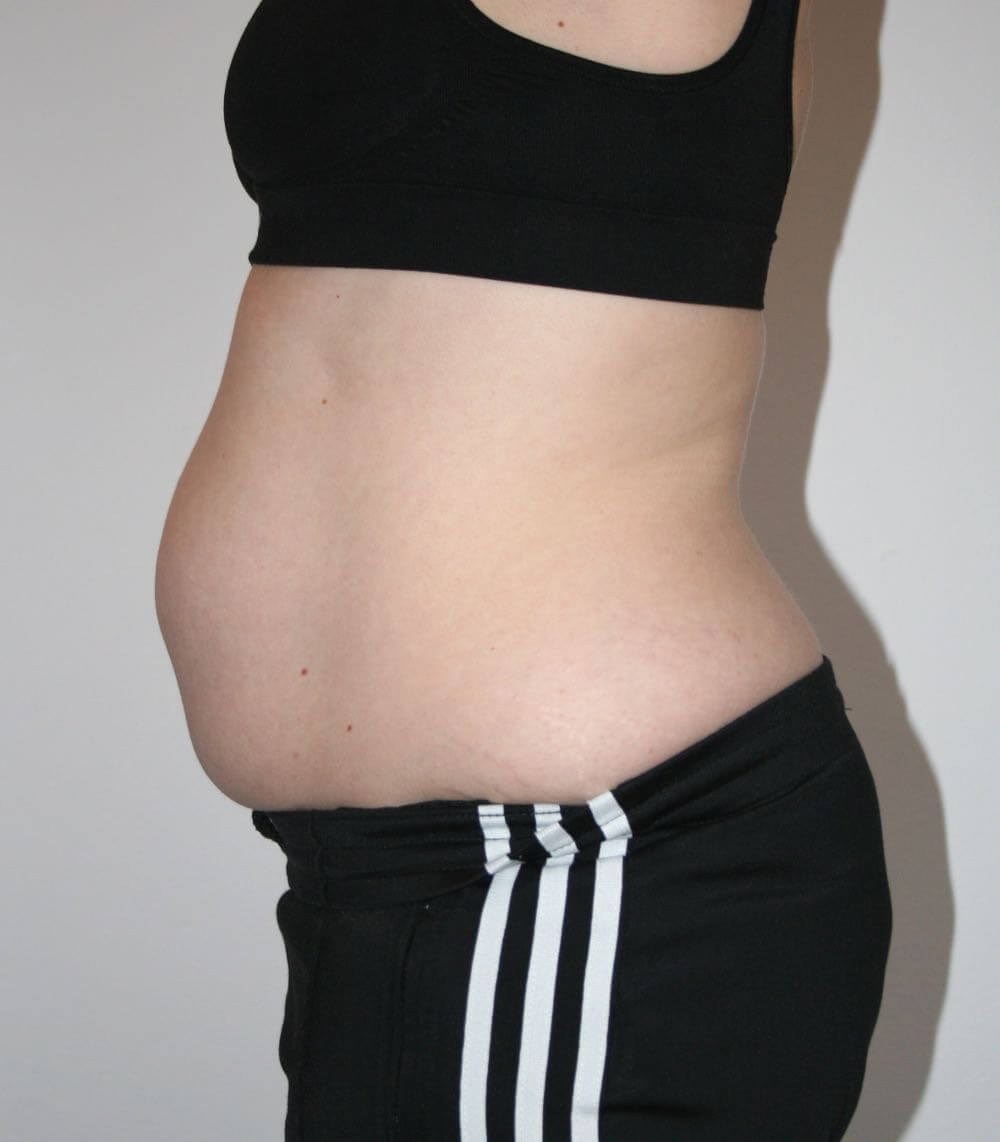 Rektusdiastase, ein nicht schwinden wollender Schwangerschaftsbauch