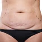 Rektusdiastase Bauch nach Geburt