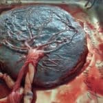 Plazenta bzw. Mutterkuchen