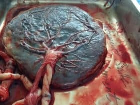 Plazenta bzw. Mutterkuchen