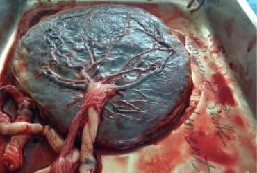 Plazenta bzw. Mutterkuchen