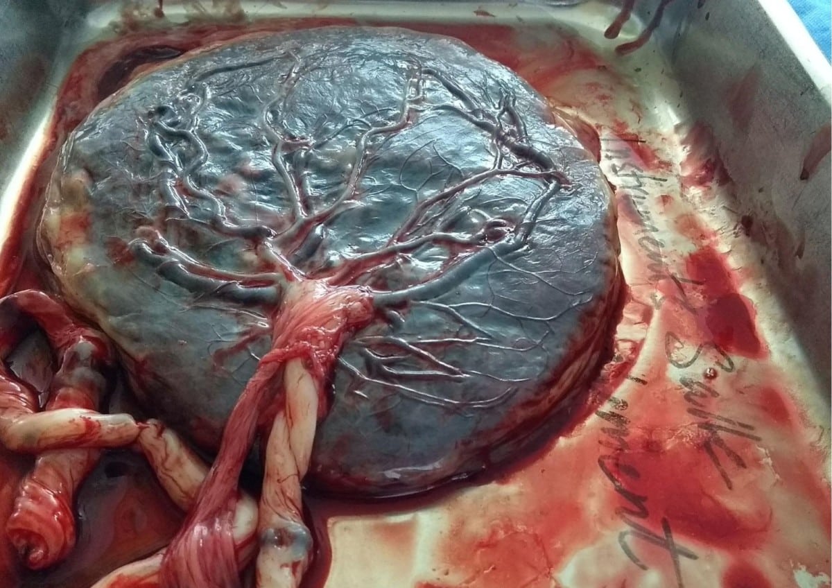 Plazenta bzw. Mutterkuchen